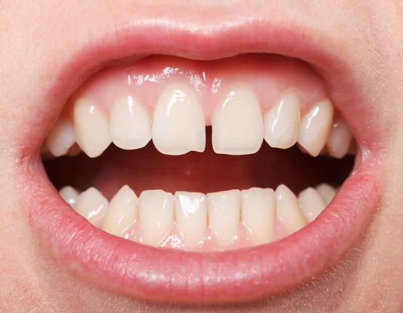 A diastema is a gap between two teeth - if it's a problem for you, cosmetic dentistry can come to the rescue!