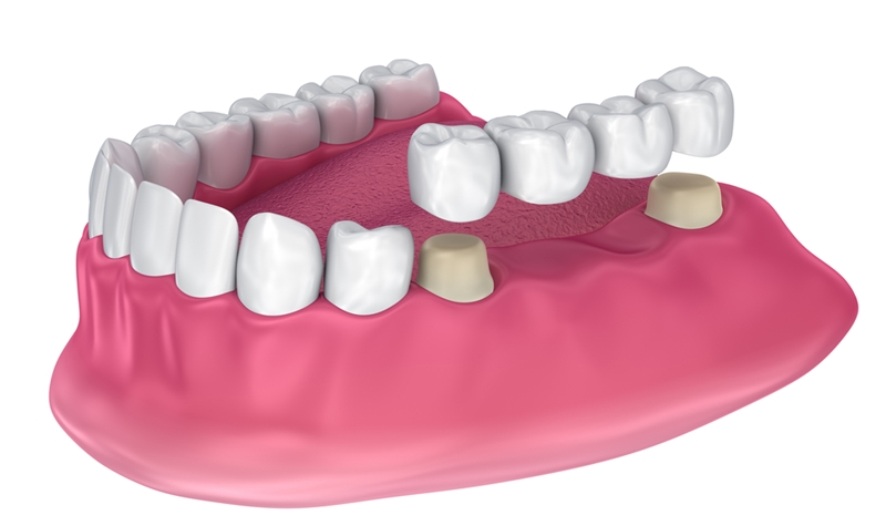 The dental bridge involves placing crowns over the teeth on either side.