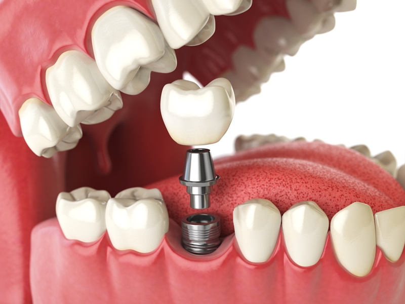 ひびの入った歯を置き換える歯科インプラント。極端な場合には、ひび割れた歯を完全に交換する必要があるかもしれません。