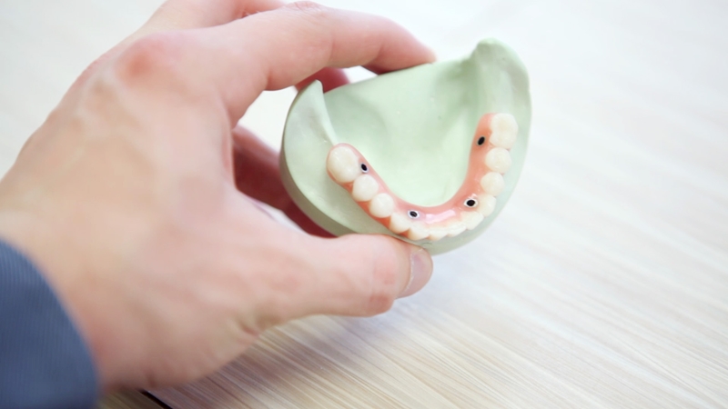 A set of teeth showing where dental implants are to be installed.